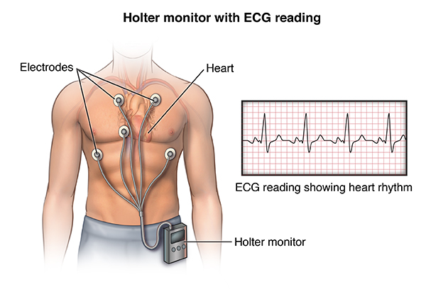 HolterMonitor Image
